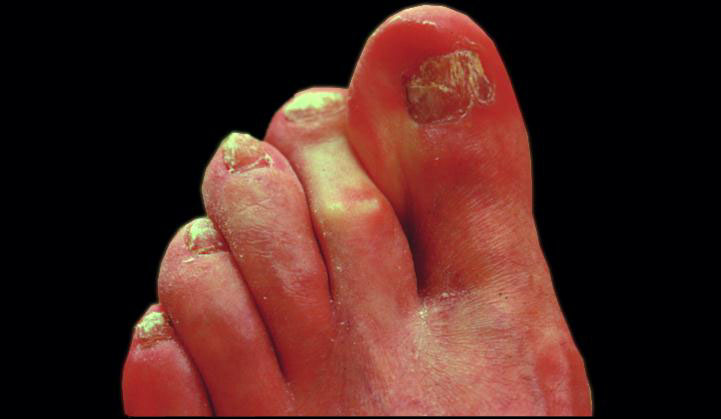 toenail fungus